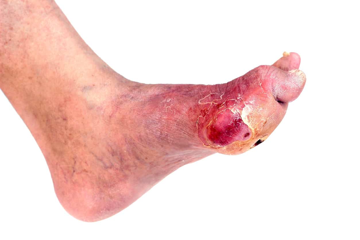 diabetes-foot-ulcer